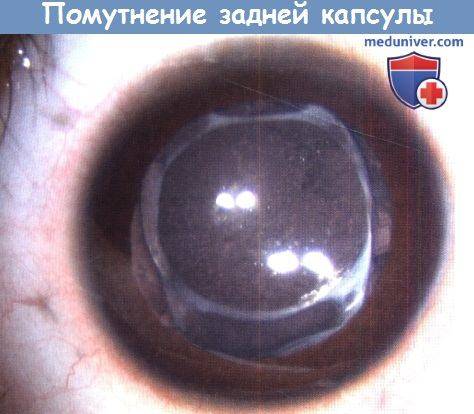 Вторичная катаракта после операции: что это такое, симптомы и лечение