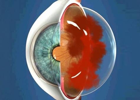 Кровоизлияние в глаз - причины, фото, что делать