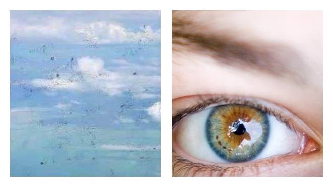 Чёрные точки перед глазами: деструкция стекловидного тела, причины появления темных пятен, способы лечения