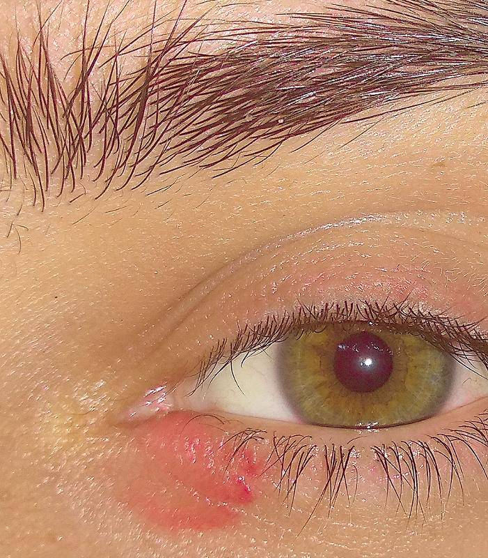 Покраснение в уголке глаза с внешней или внутренней стороны: причины, лечение, что делать, если краснота чешется, какие это заболевания