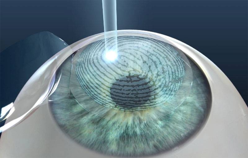 Лазерная коррекция зрения: фрк, lasik, epi-lasik, как проходит, ограничения, реабилитация, преимущества и недостатки
