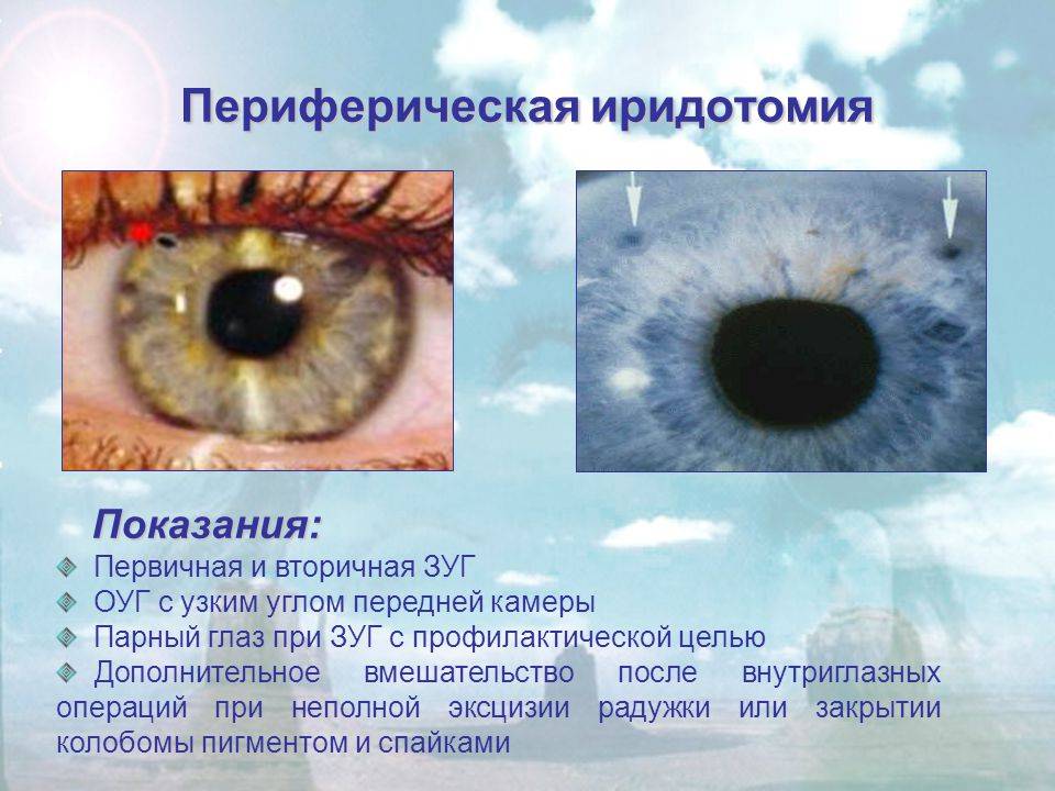 Иридэктомия: лазерное лечение глаукомы, последствия операций
