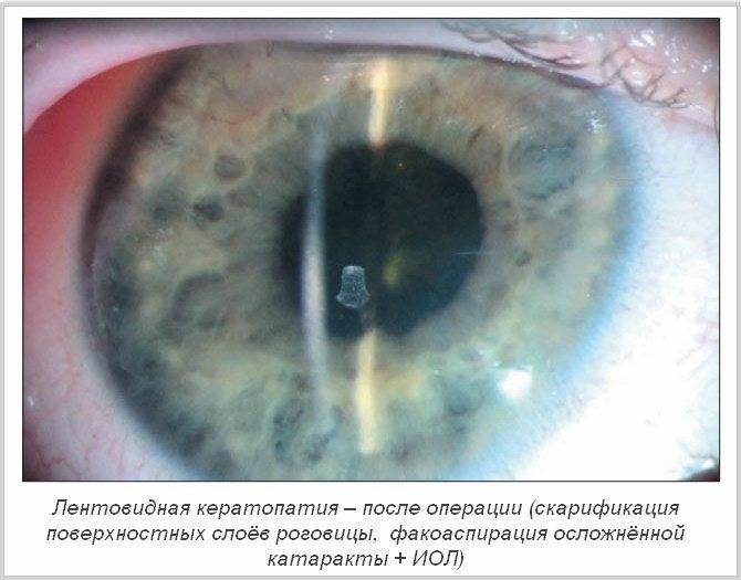 Зрение после замены хрусталика, реабилитация после операции, осложнения