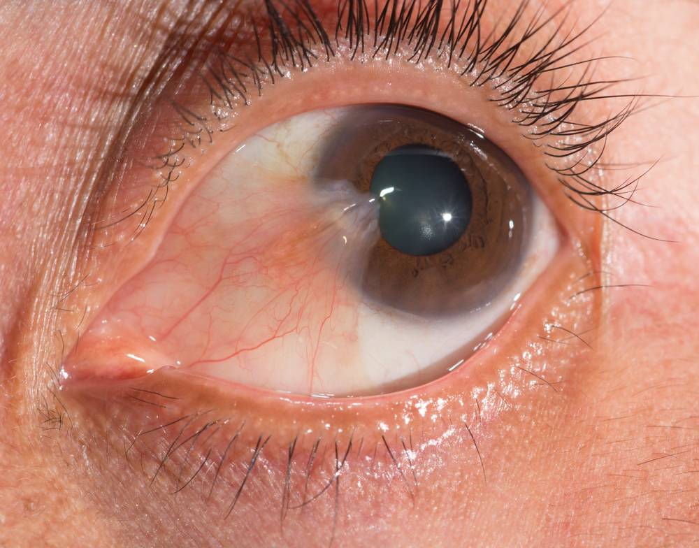 Птеригиум глаза: симптомы и лечение - "здоровое око"