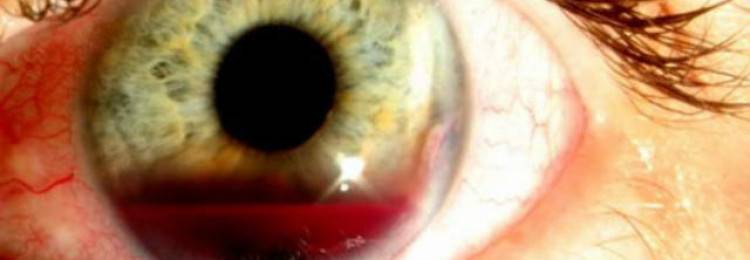 Гифема (кровоизлияние в переднюю камеру глаза): что это такое, симптомы, причины, лечение (капли и прочие средства), прогноз и другие аспекты