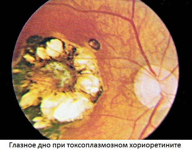 Хориоретинит - сложное воспалительное заболевание глаз