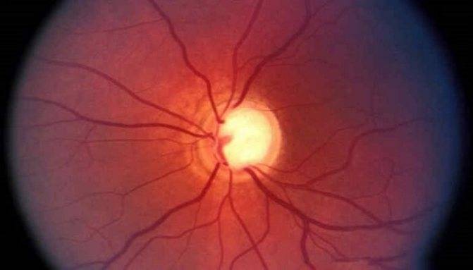 Ангиопатия сетчатки глаза - что это такое, симптомы и лечение
