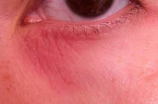 Трещины и шелушение кожи вокруг глаз - причины и лечение