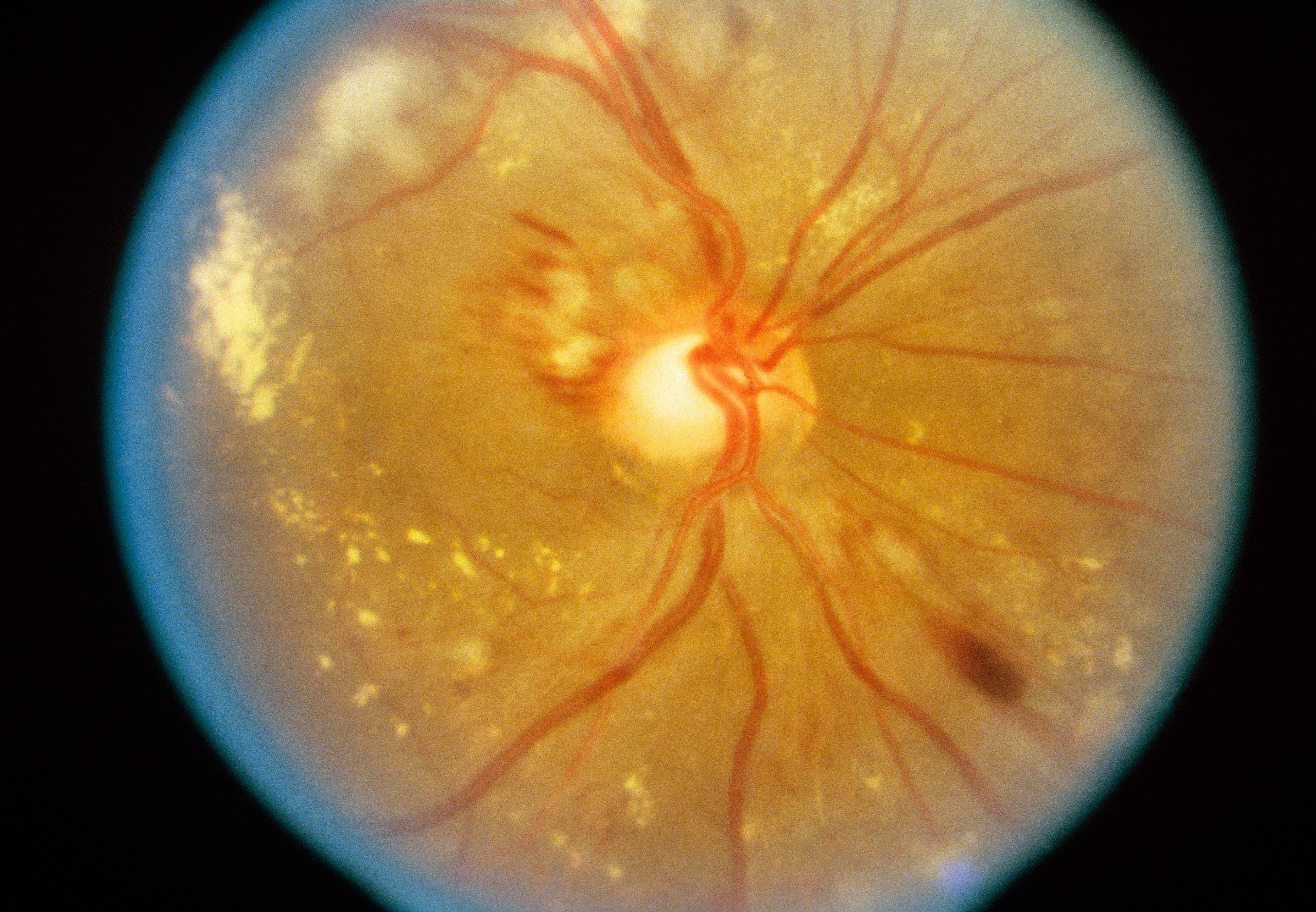 Сетчатка глаза — болезни и лечение