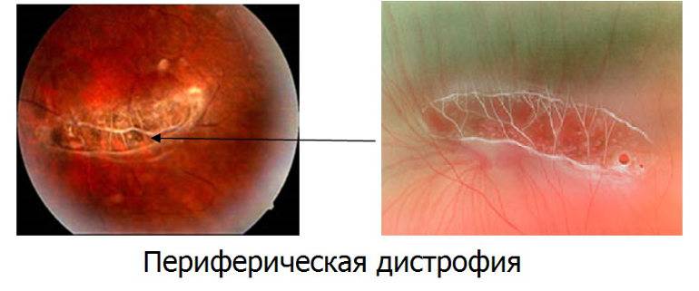 Дистрофия сетчатки периферическая пвхрд. все о глазных болезнях.