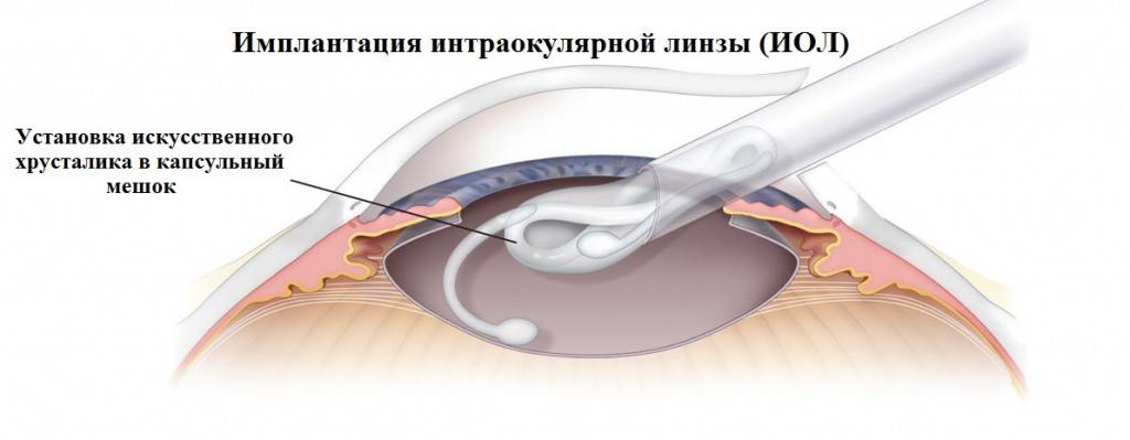 Реабилитация после замены хрусталика при катаракте