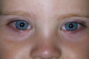 Что делать когда лопнул сосуд или полопались капилляры в глазу ребенка