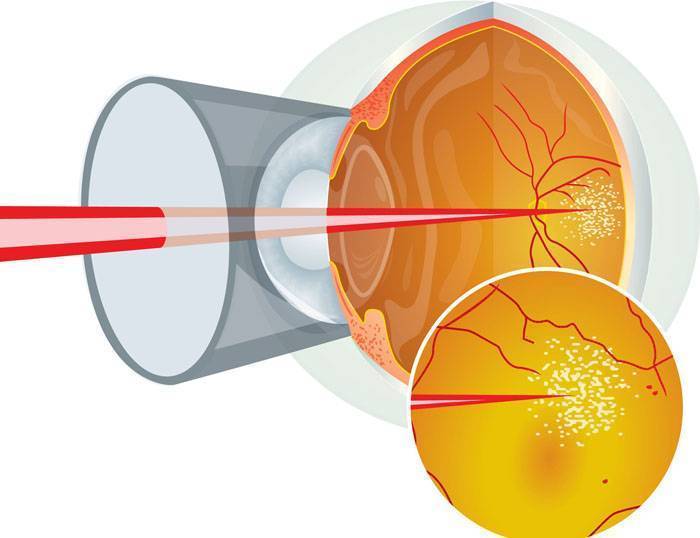 Лазерная коагуляция сетчатки глаза в москве: стоимость операции, показания и противопоказания