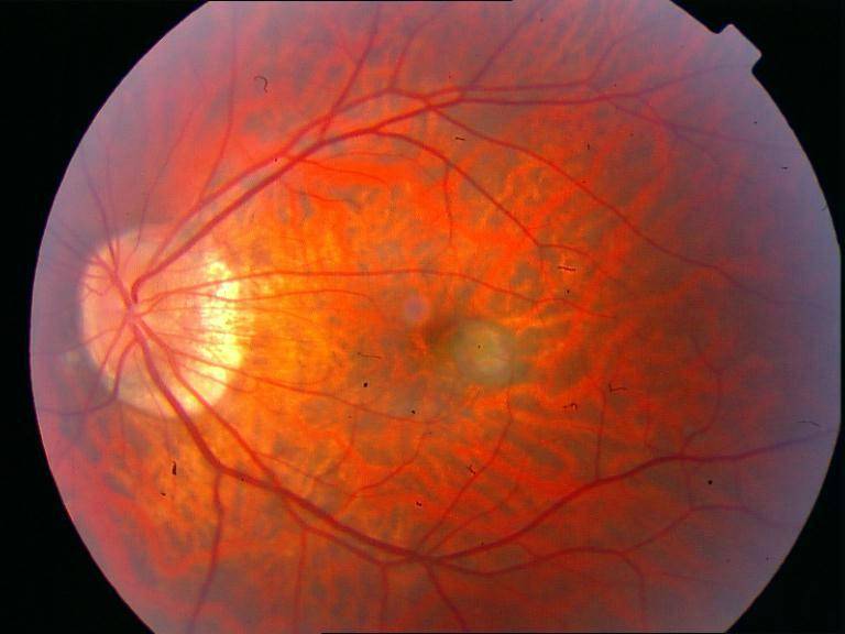 Миопическая болезнь - лечение глаз