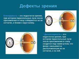 Близорукость: это минус или плюс, какие очки и линзы применяют при миопии