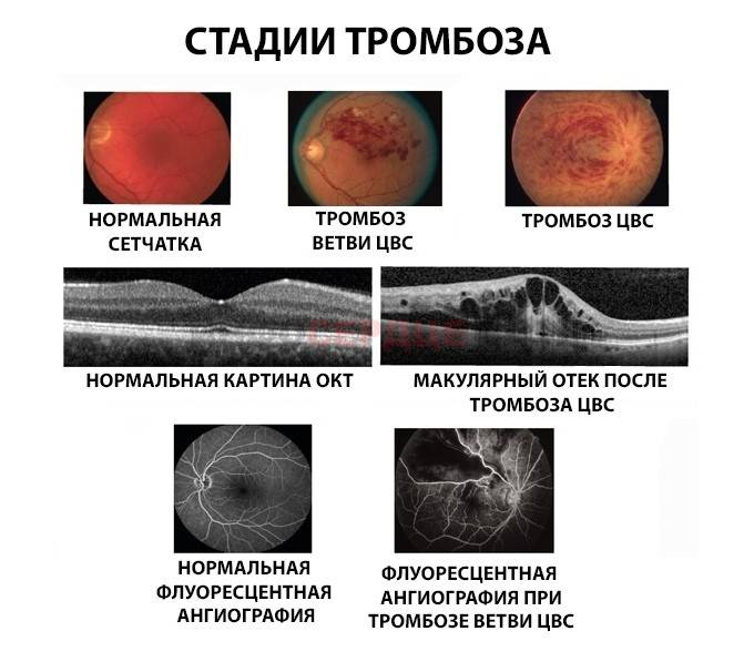 Методы лечения тромбоза центральной вены сетчатки