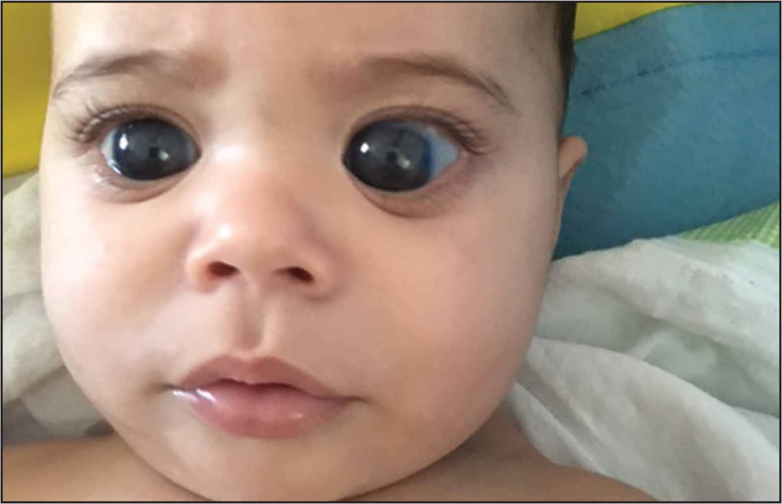 Врожденная глаукома у детей: симптомы, признаки, лечение ребенка, код по мкб, фото