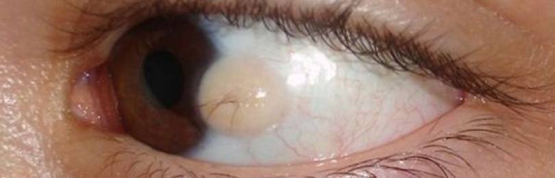 Киста на глазу: симптомы, причины, все виды лечения