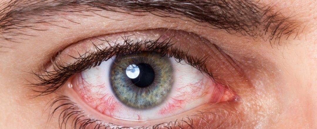 Красные глаза - причины, от чего краснеют глаза и что делать