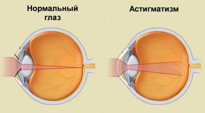 Что такое астигматизм глаз и как его лечить у детей