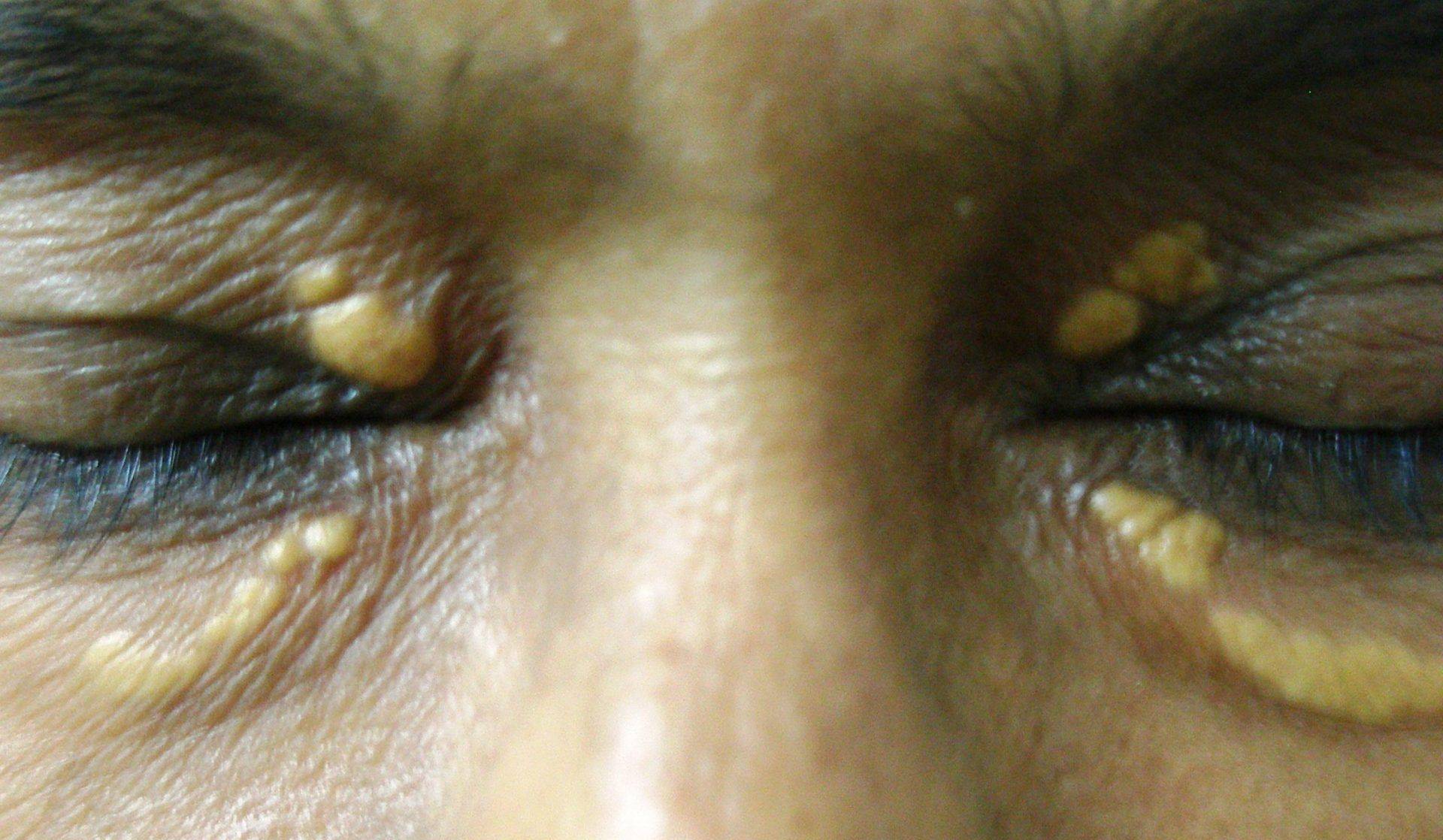 Желтое пятно на белке глаза - причины появления