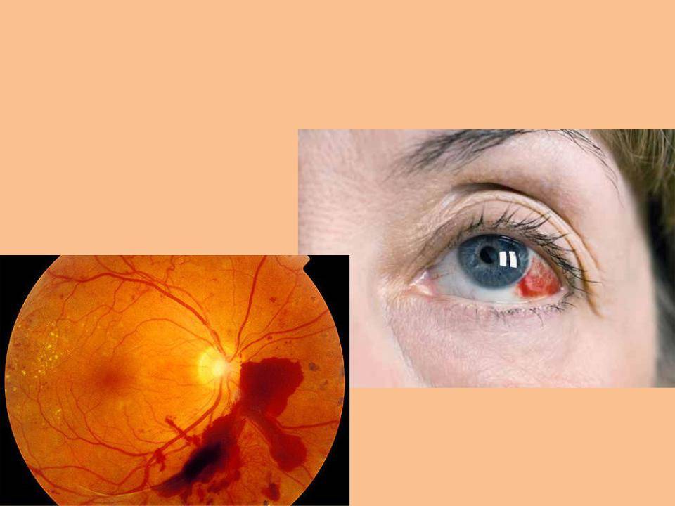 Химические ожоги глаз - лечение, осложнения