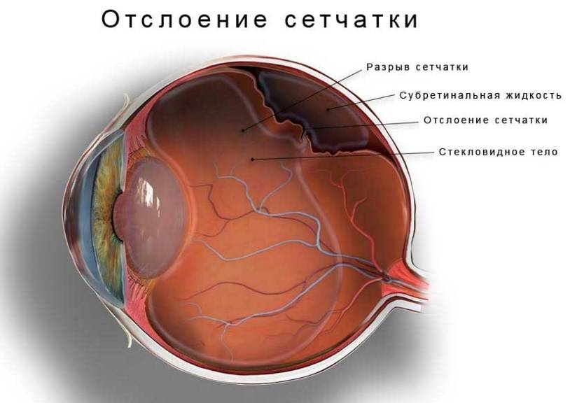 Болезни сетчатки глаза