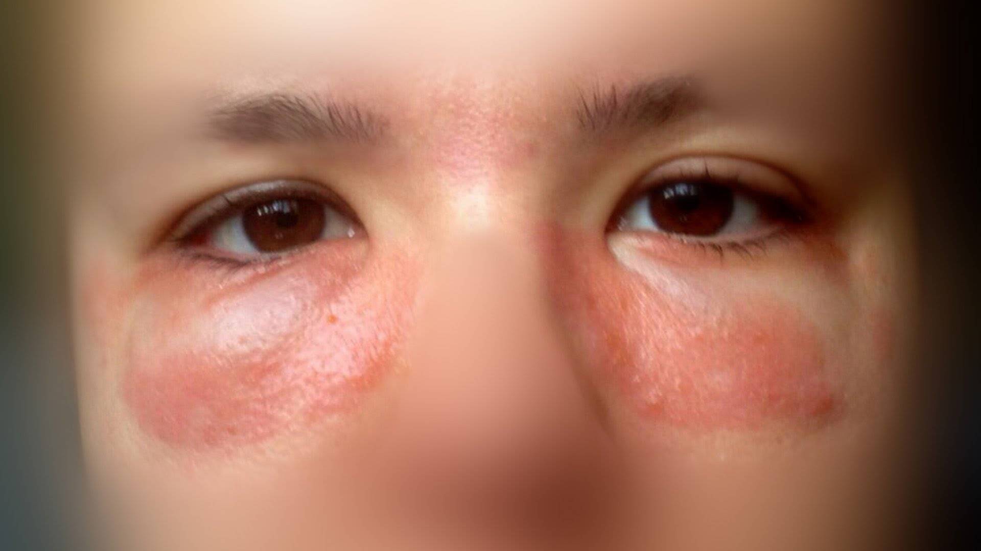 Аллергия глаз как лечить