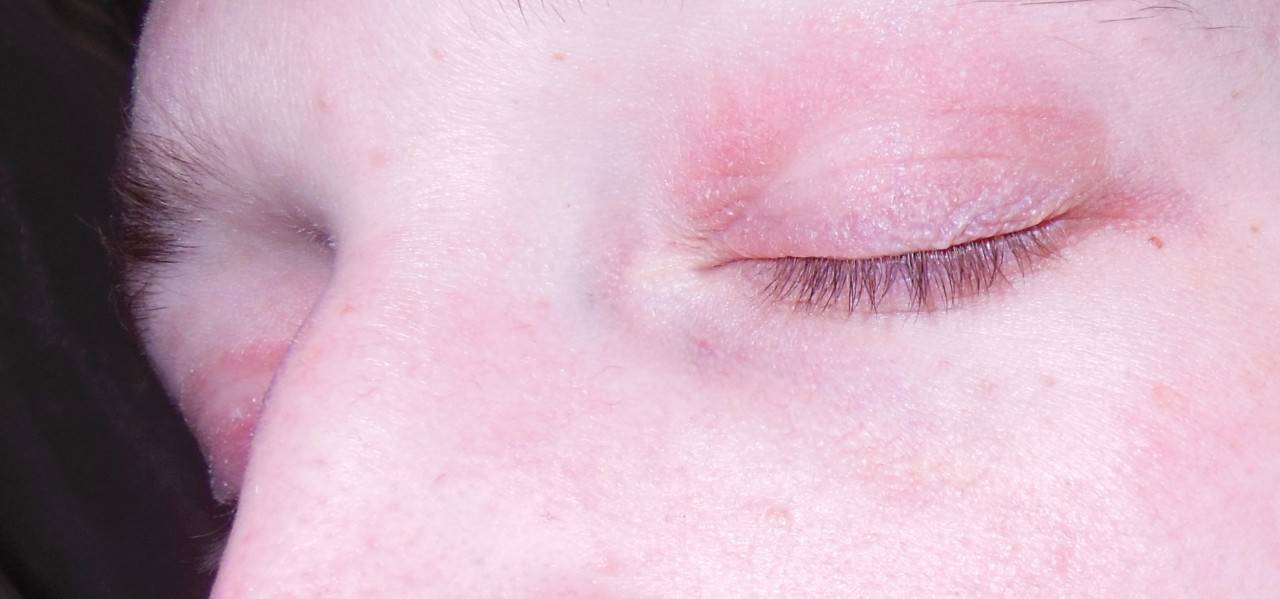 Трескается кожа во внешних уголках глаз. лечение экземы век: причины появления и симптомы у взрослых, и детей