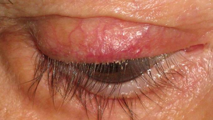 Блефарит чешуйчатый: симптомы и лечение заболевания