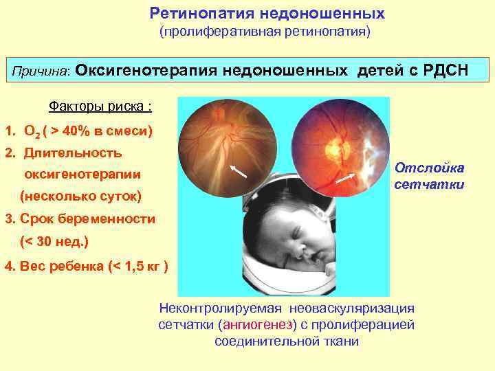 Возможно ли вылечить ретинопатию недоношенных и как ее определить?