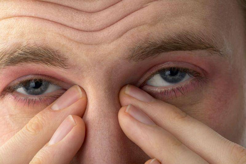 Как быстро избавиться от опухших глаз после слез утром. как убрать отеки глаз после слез?