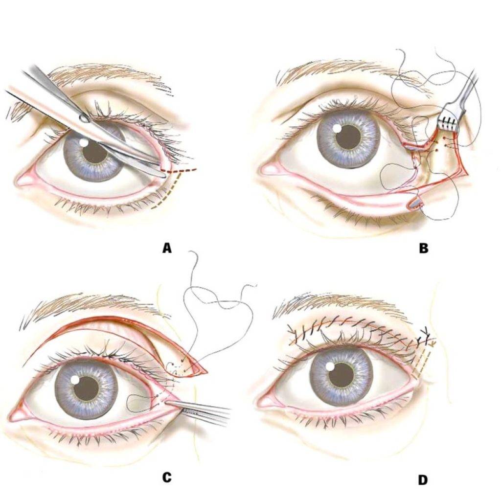 Глазные операции - какие они бывают