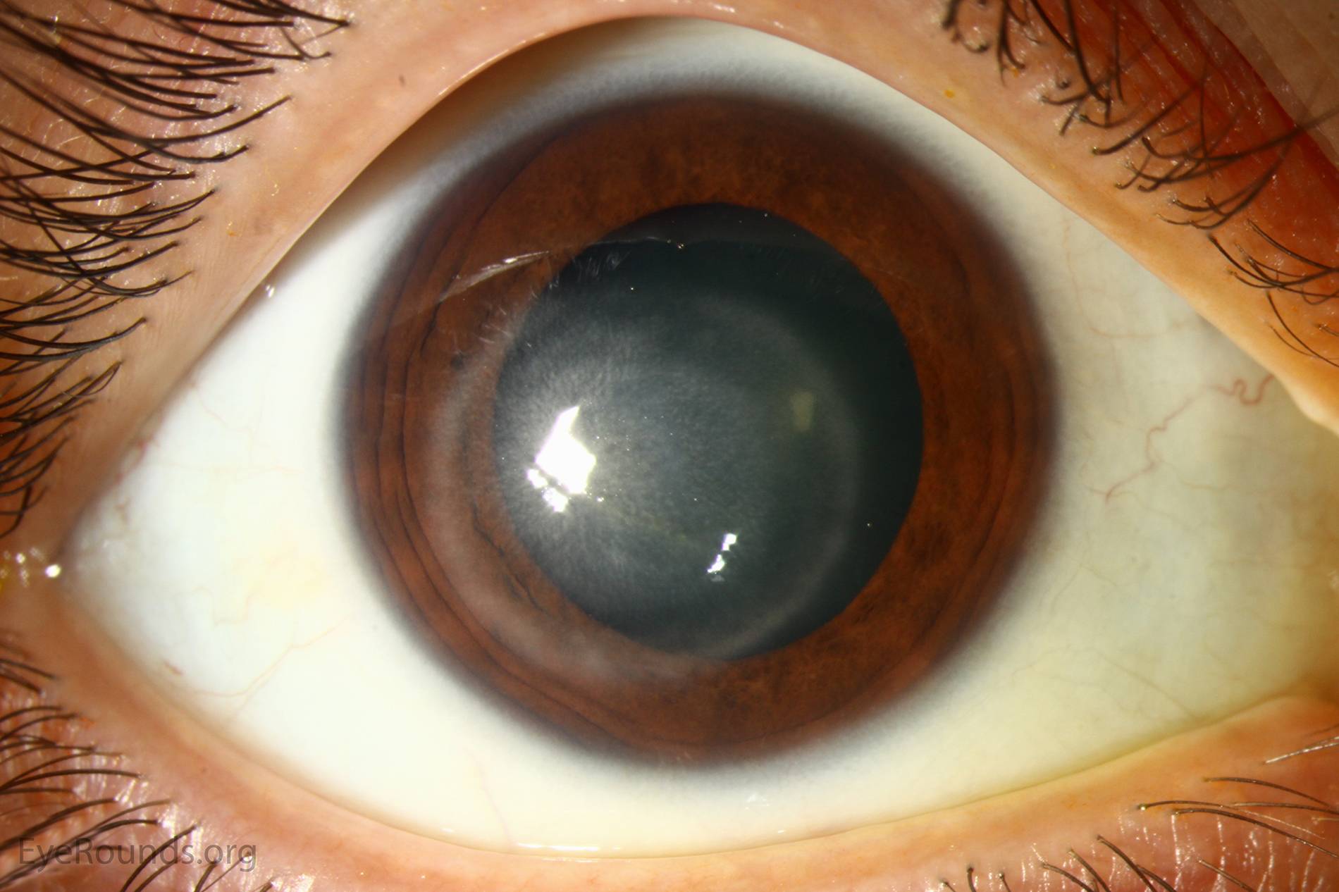 Кератит глаз