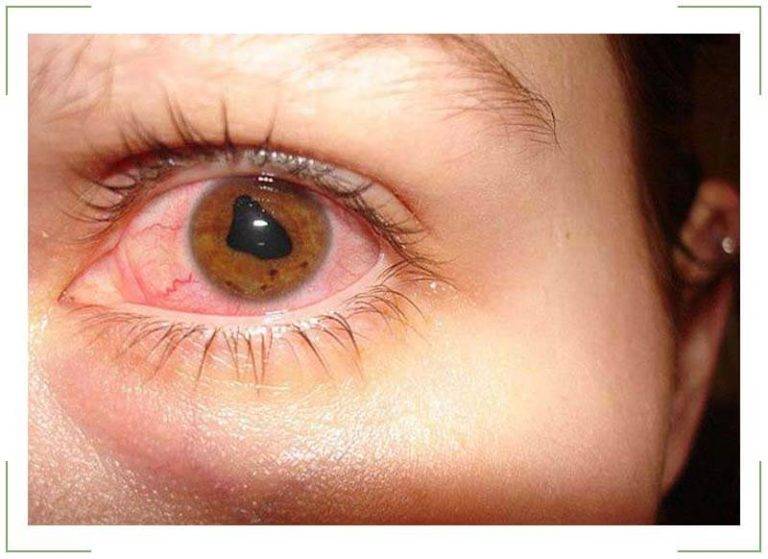 Боль в глазу при движении глазного яблока: причины и методы лечения - "здоровое око"