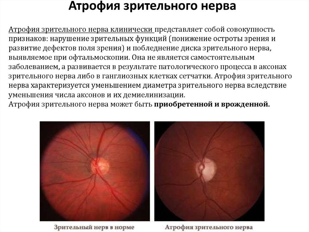 Атрофия зрительного нерва, симптомы заболевания, способы диагностики и лечения.
