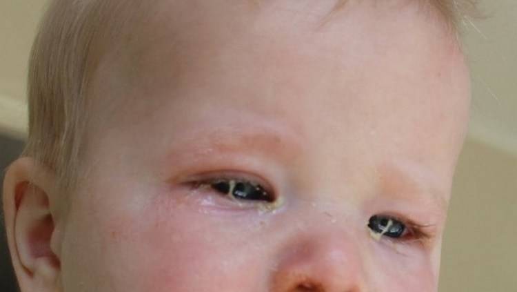 Как лечить глаза у новорождённого, если они закисают oculistic.ru
как лечить глаза у новорождённого, если они закисают