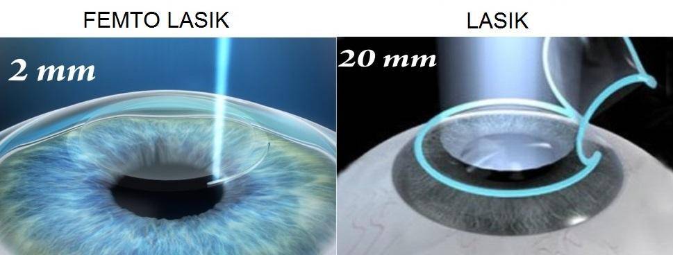 Relex smile лазерная коррекция зрения: особенности метода, отзывы пациентов, возможные осложнения