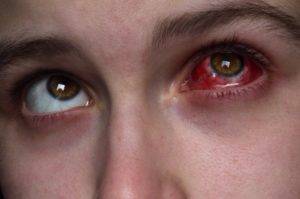 Как лечить субконъюнктивальное кровоизлияние в сетчатку глаза и что делать когда идет кровь в стекловидное тело
