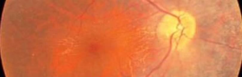 Сенильный ретиношизис
