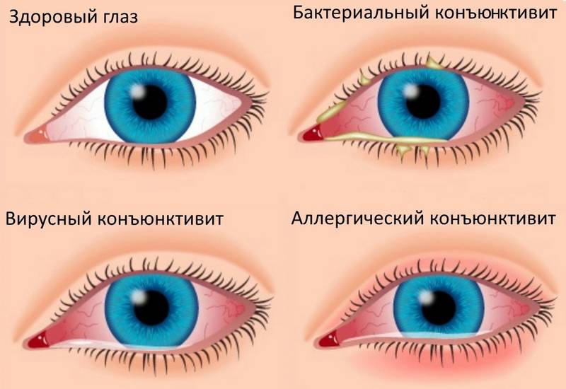 Заболевание глаз у человека - список глазных болезней зрения, лечение офтальмологических у взрослых, какие бывают инфекционные у людей