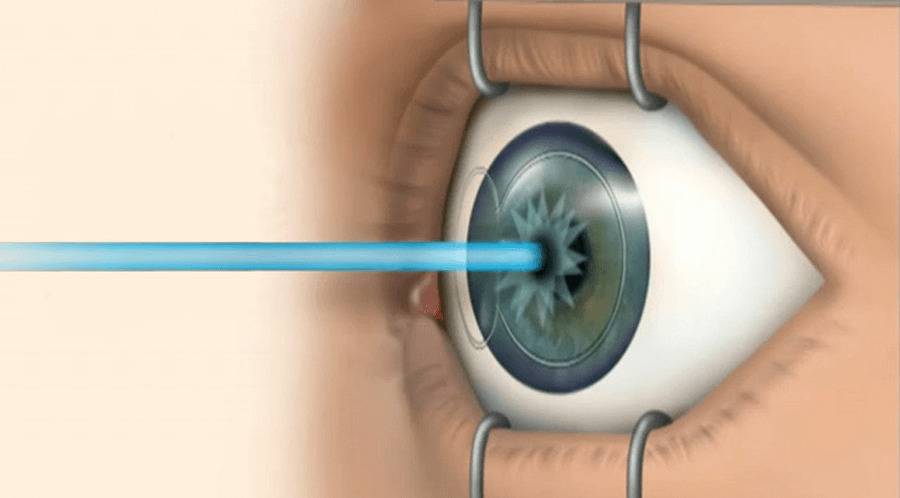 Лечение катаракты лазером отзывы - лечение глаз