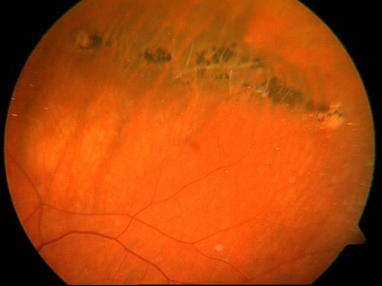 Образование мембраны на сетчатке или эпиретинальный фиброз глаза: что это такое и каково его лечение