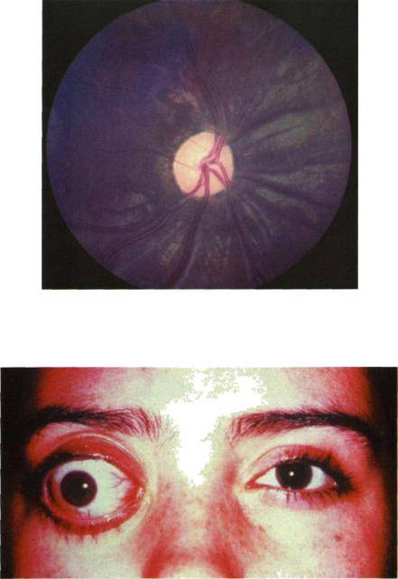 Атрофия зрительного нерва - причины, симптомы, диагностика и лечение атрофии зрительного нерва | ао «медицина» (клиника академика ройтберга)