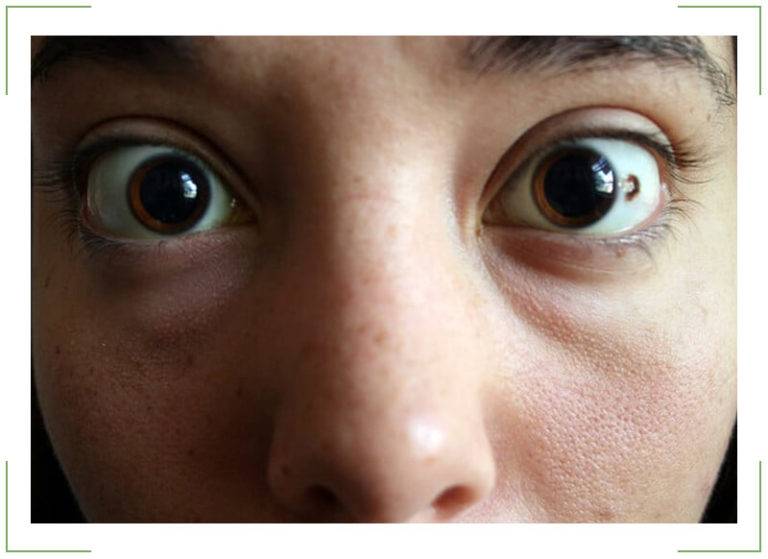 Причины экзофтальма одного глаза или обоих, симптомы и лечение