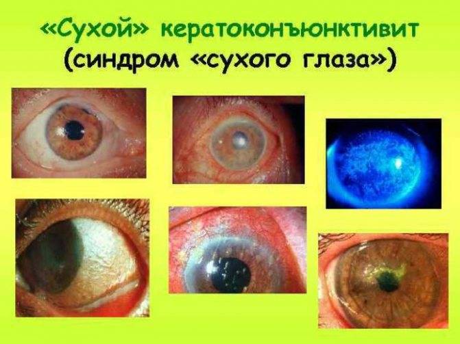 Синдром сухого глаза: причины, симптомы, лечение сухости, препараты, капли, диагностика, что такое, кератоконъюнктивит