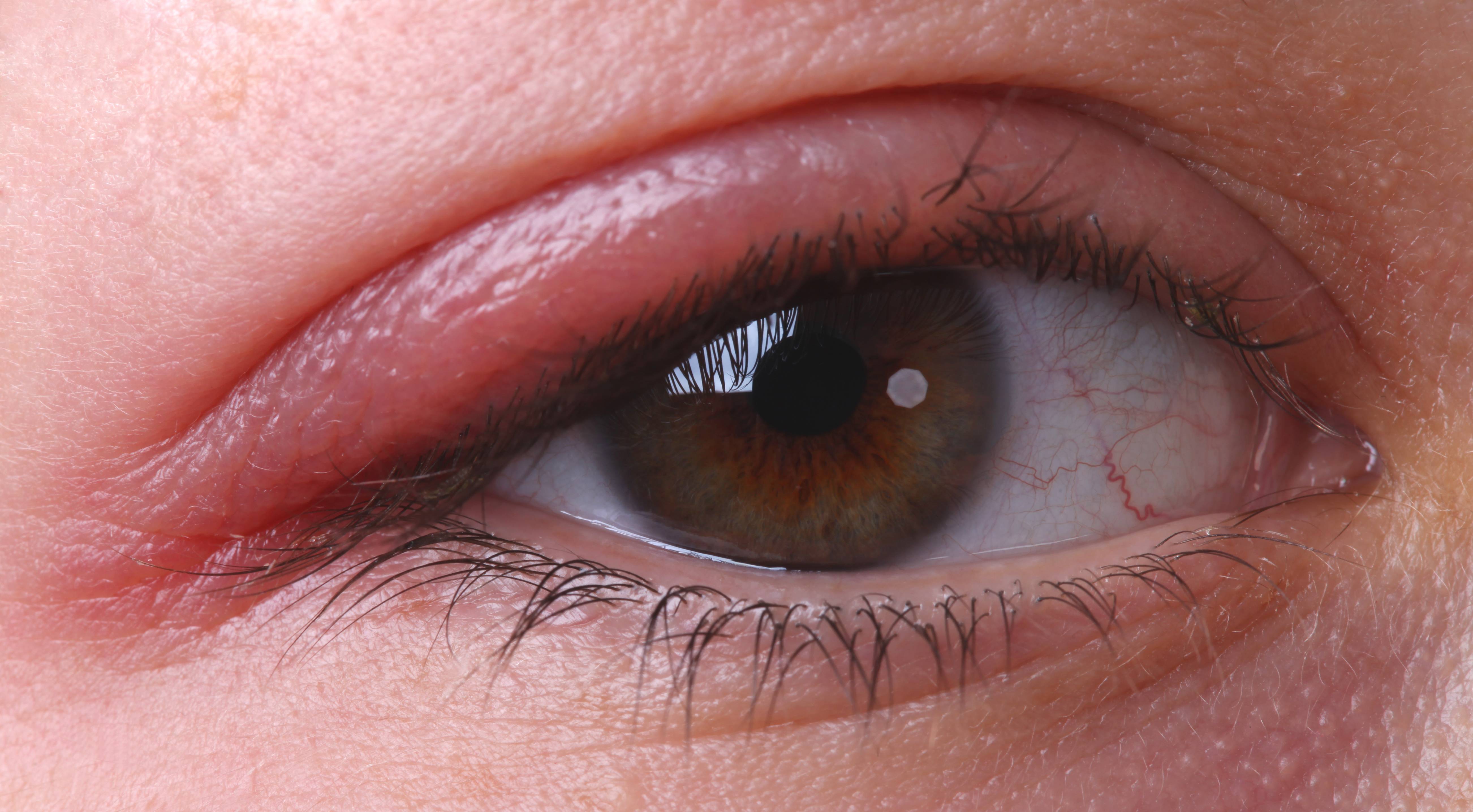Глаза красные и чешутся - что делать, лечение, причины и симптомы