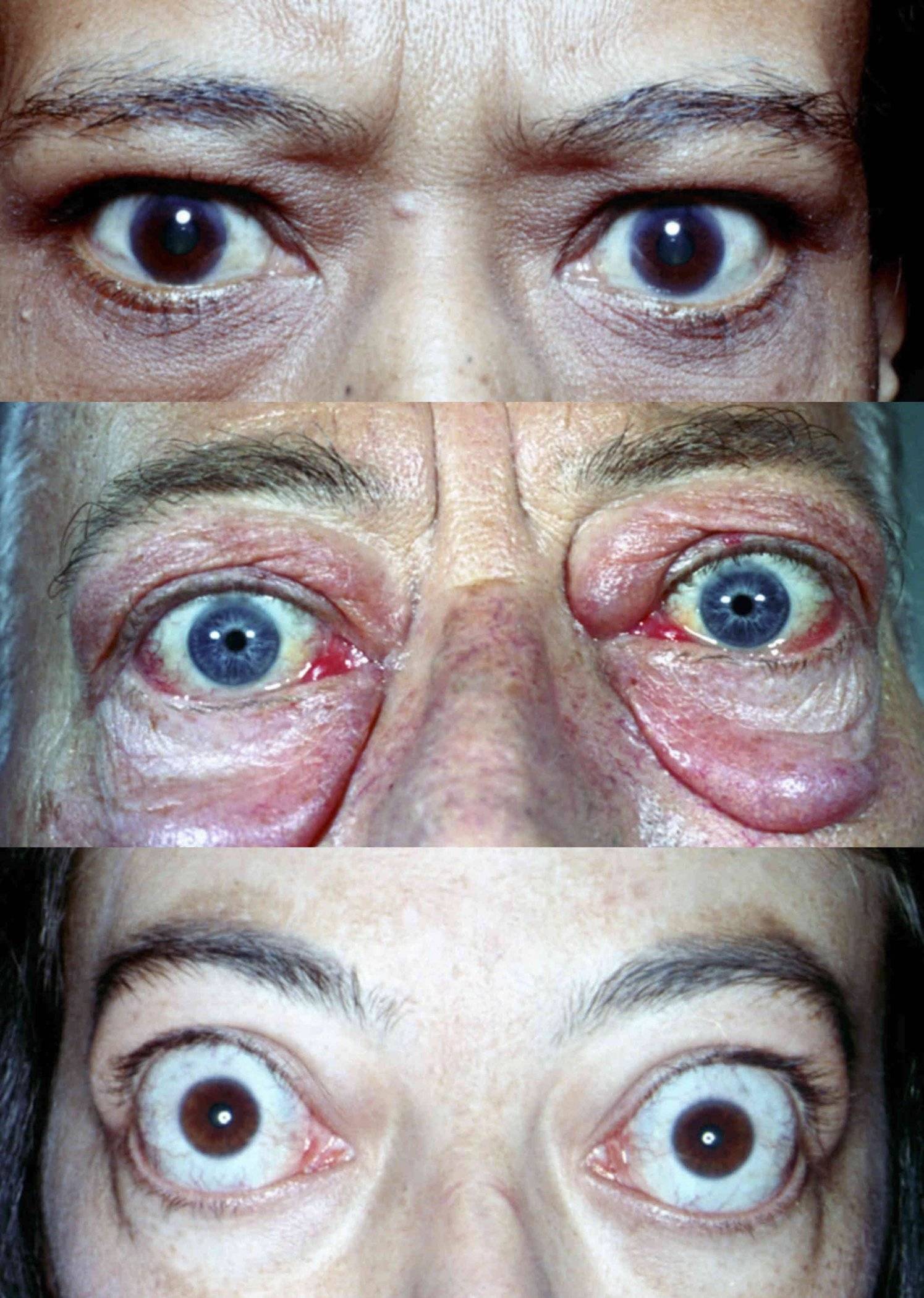 Увеличение глаза и пучеглазость — экзофтальм