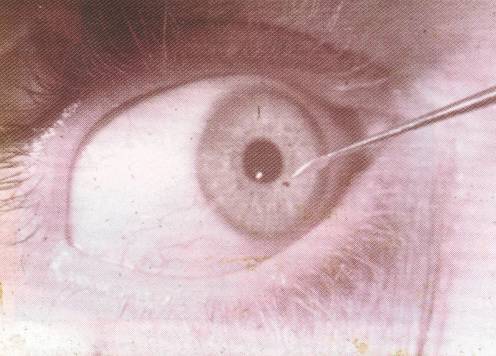 Ощущение инородного тела в глазу: симптомы, болезни и методы лечения - "здоровое око"