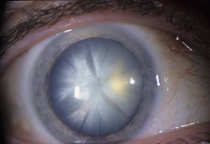 Незрелая катаракта: симптомы и лечение. нужна ли операция?